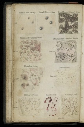 Measles symptoms 1846